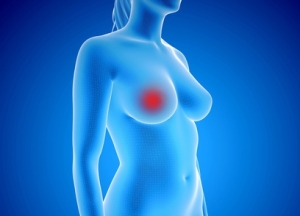 3d rendered illustration of breast cancer breast cancer