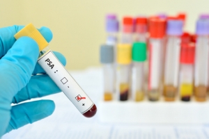 Blood sample with PSA (Prostate-specific antigen) positive prostate specific antigen PSA test