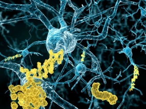 Alzheimer Krankheit – Neuronen mit Amyloid-Plaques amyloid plaques Alzheimer's